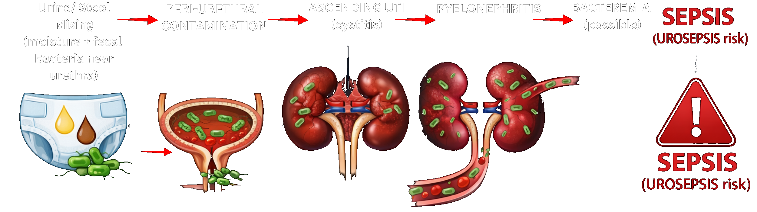 Diagram showing contamination pathway from urine/stool mixing through ascending UTI, pyelonephritis, bacteremia to urosepsis